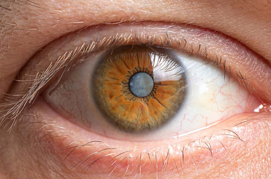 congenital-cataract