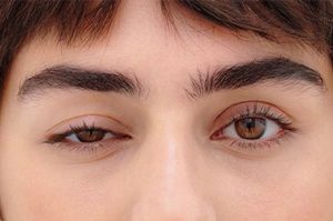 پتوز یا افتادگی پلک Ptosis