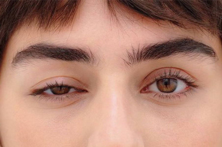 پتوز یا افتادگی پلک Ptosis