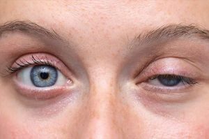 افتادگی پلک (Ptosis)